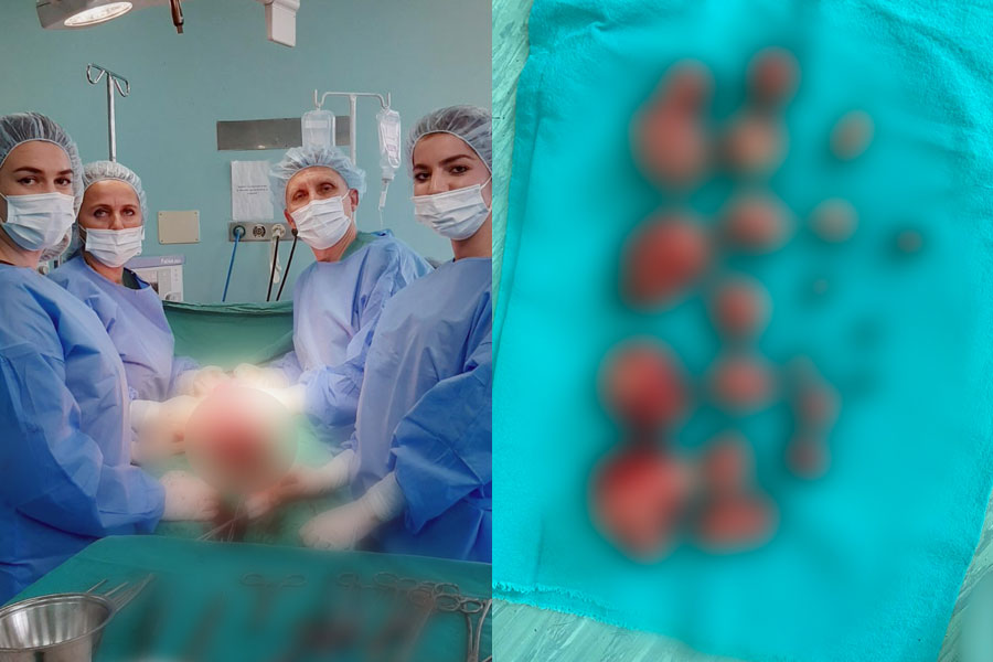 operacion-i-komplikuar-ne-shskuk,-pacientes-i-hiqen-21-miome