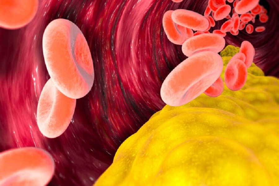 kolesteroli-i-ngritur-mund-te-tregohet-edhe-nga-nje-ndjenje-e-pazakonte-ne-kembe