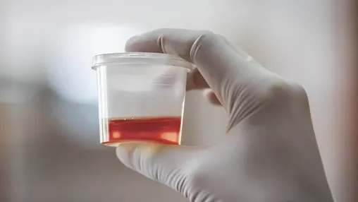 gjaku-ne-urine:-cfare-e-shkakton-dhe-kur-duhet-te-shqetesoheni?