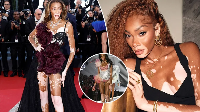 winnie-harlow:-nje-vajze-e-bullizuar-si-femije-qe-per-pak-la-shkollen-–-ndersa-sot-nje-modele-e-klasit-boteror-dhe-sipermarrese-e-suksesshme